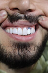ایمپلنت در رشت