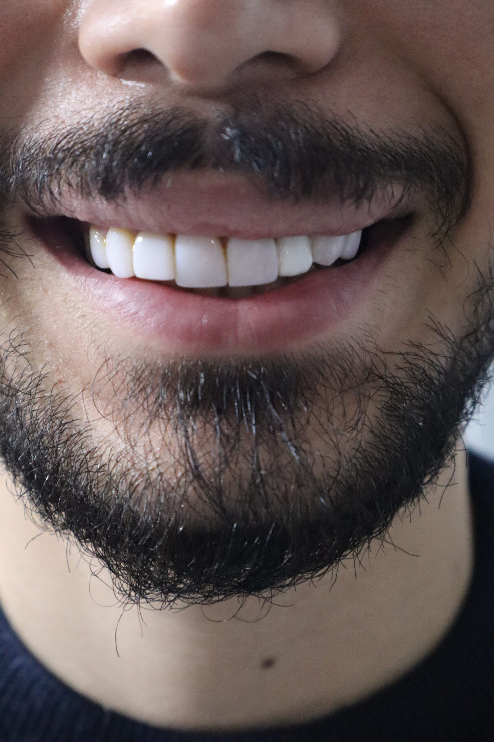 ایمپلنت دندان در شهر رشت